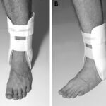 Ankle Taping Vs Bracing